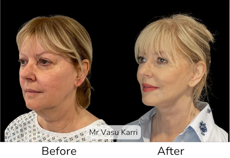 Facelift Patient 11 View 2